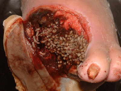 Diagnosis of necrotizing fasciitis with bedside ultrasound ...